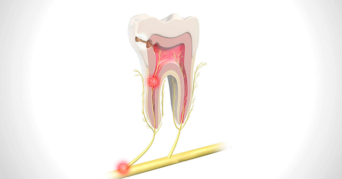 Удаление нерва в зубе: кому, когда, зачем