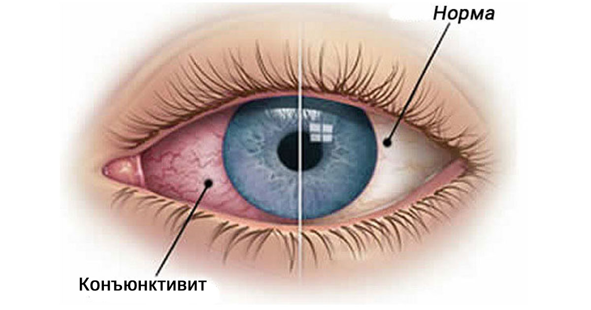 Конъюнктивит | Клиника Добрый Доктор